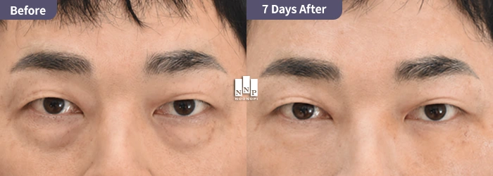 Asian eyebag repositioning surgery before and after