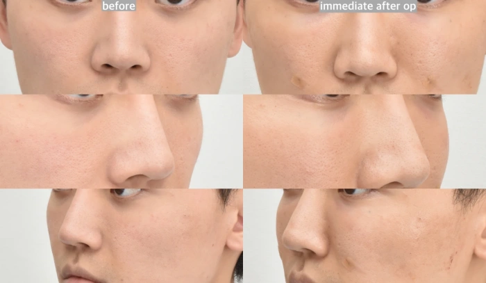 纳米脂肪移植后眼周肿胀更轻