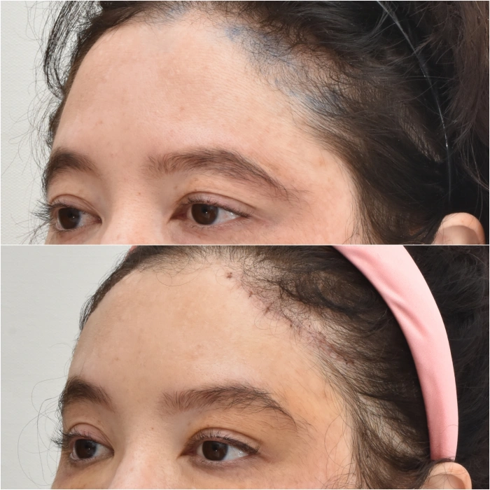 Korea fox eye lift before after