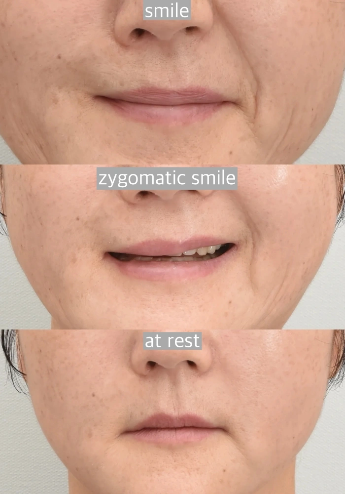 تأثير خطوط الابتسامة في المرضى الذين يعانون من شلل الوجه