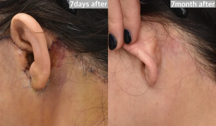 耳后疤痕随时间变化（放大图）