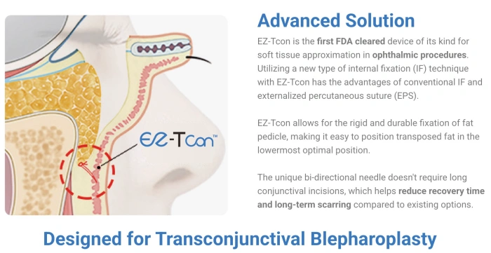 خيط تثبيت داخلي يلغي الحاجة إلى خروج الجلد بعد الجراحة