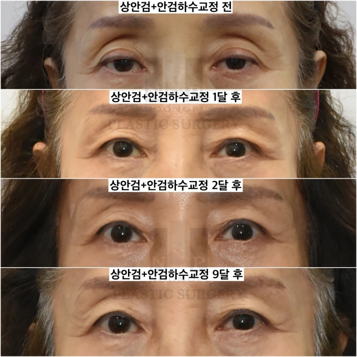 상안검 및 눈매교정 동시 수술 사례