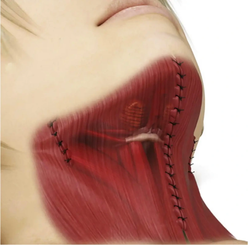 Platysma tightening