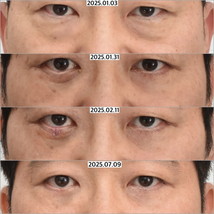 تم إجراء استئصال إسفيني خماسي لإعادة بناء الجفن السفلي الصلبي على الجانب الأيمن