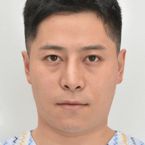 noonopi诊所暗圈套餐治疗后6个月