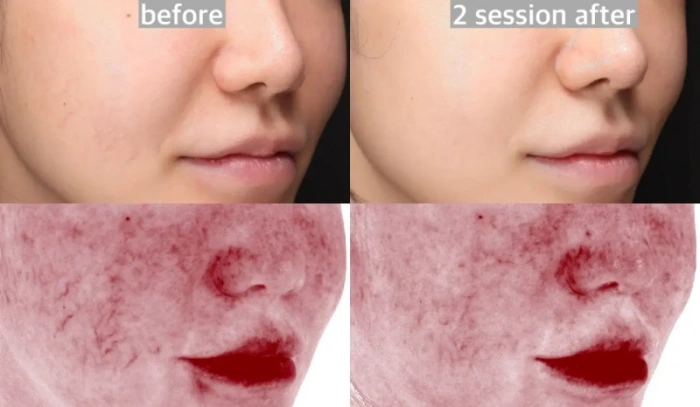 Results of facial vessel with BBL