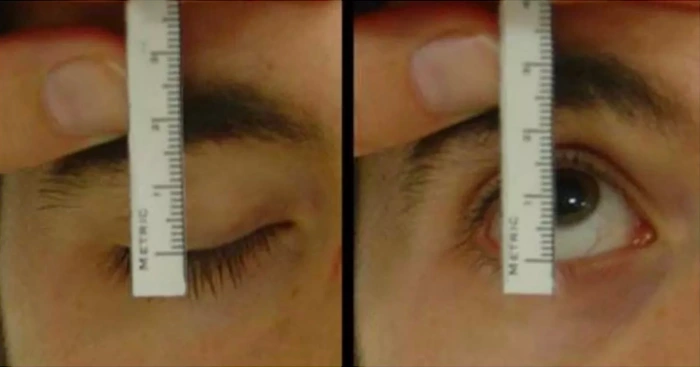 توضيح حركة الجفن باستخدام طريقة بيرك