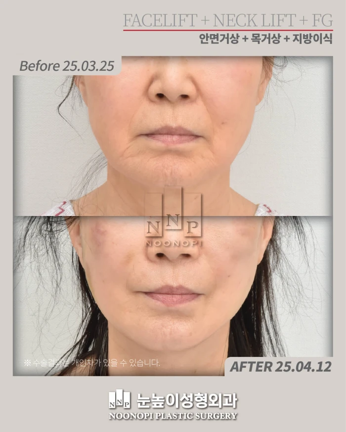 눈높이성형외과에서 안면거상 목거상 19일 후 부기가 매우 적은 모습