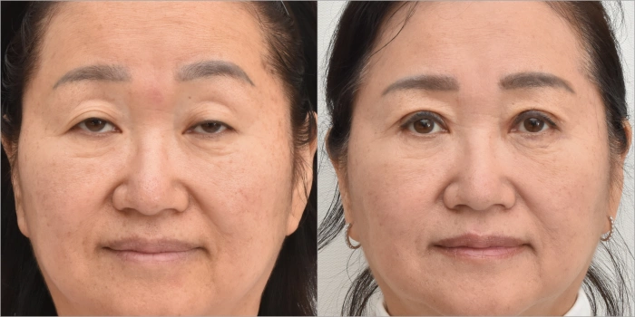 Case of bilateral eyelid correction despite unilateral ptosis: 2 weeks
