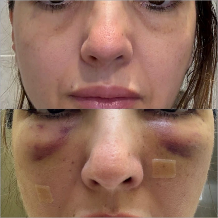 هناك حاجة إلى تصحيح طفيف في زراعة الدهون بسبب الامتصاص (اليوم الأول بعد الجراحة)