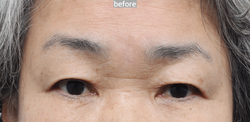 no forehead muscle involves during eye opening