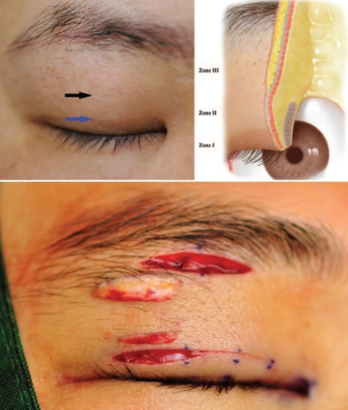 eyelid lift comparison