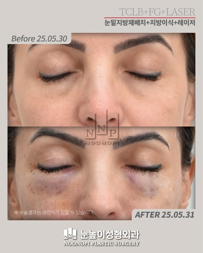 韩国下眼睑脂肪移植