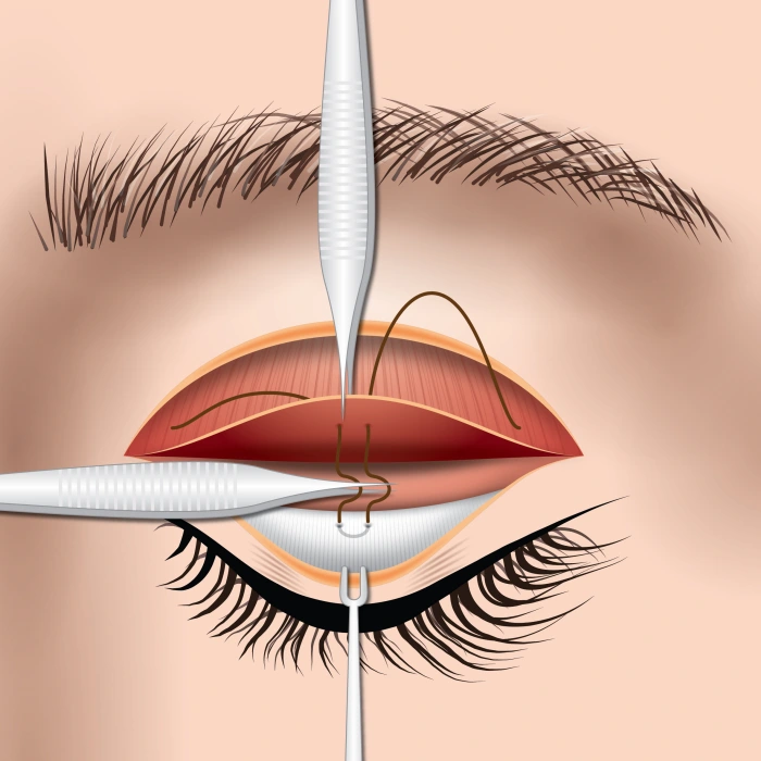 解开临时结节，保留缝线于睑板