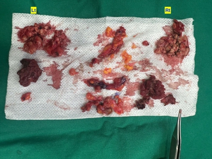 双下巴手术后切除组织的外观