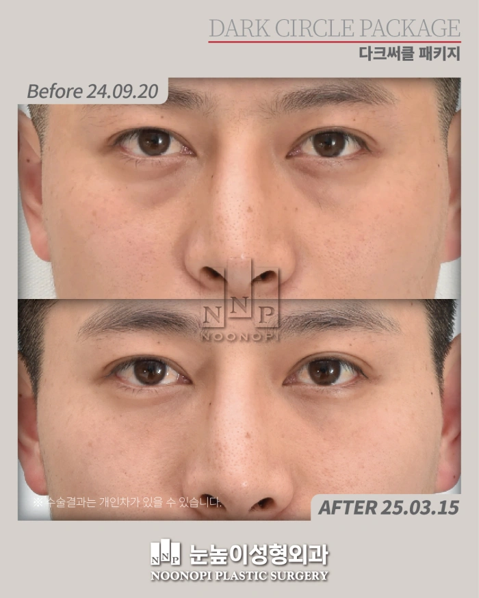 Noonopi诊所眼下脂肪重塑术前后对比图，清晰展现眼袋与黑眼圈改善效果
