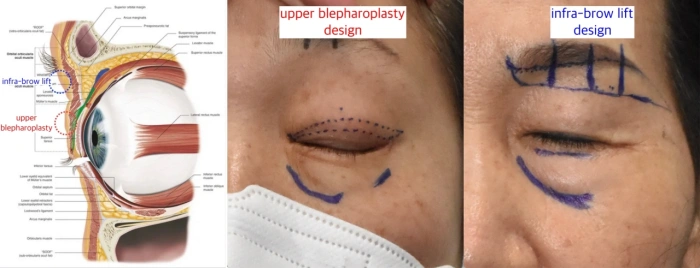 Comparison of two upper lid lift procedures