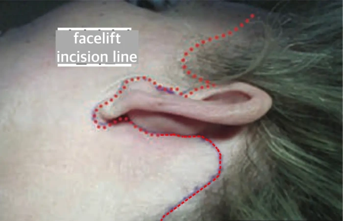 facelift incision location