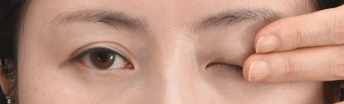 عندما يتم تغطية العين السائدة المصابة بمرض تدلي الجفن، قد تبدو العين غير المصابة بالمرض والتي تعوض بشكل مفرط أصغر حجمًا