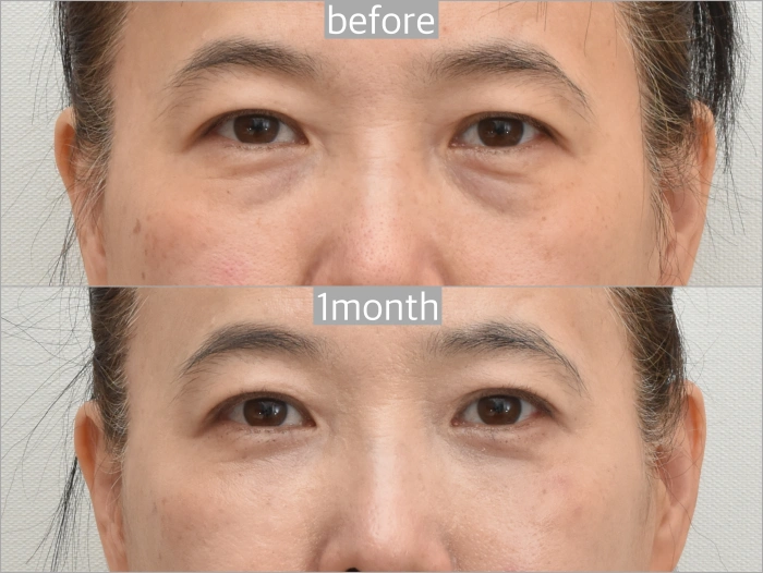 before and after photo of lower eyelid blepharoplasty