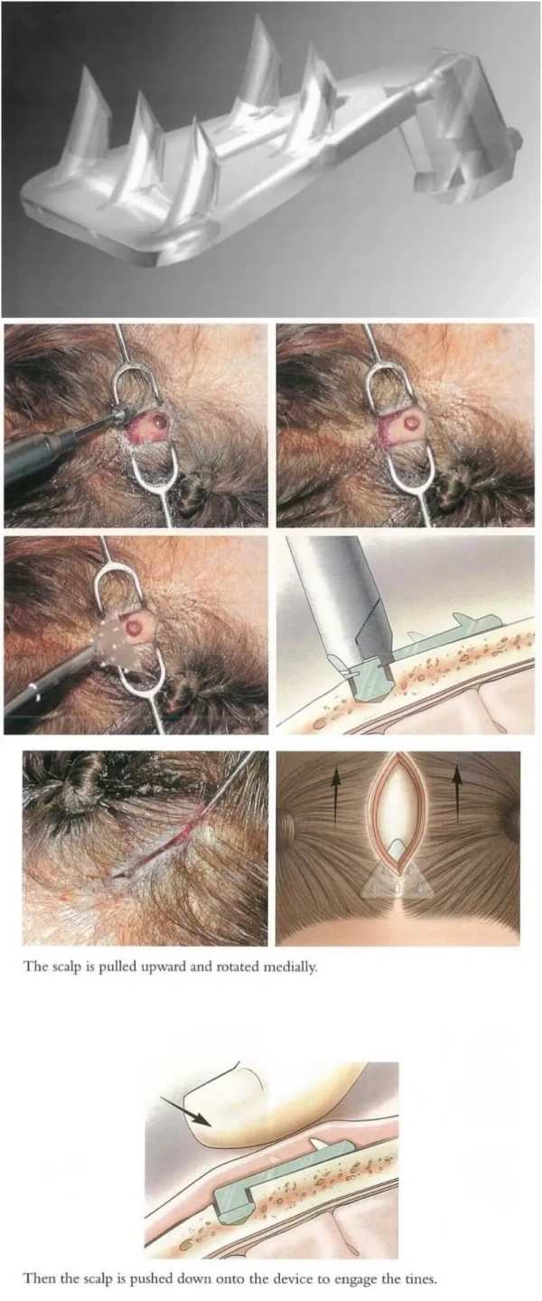 endotine forehead fixation method
