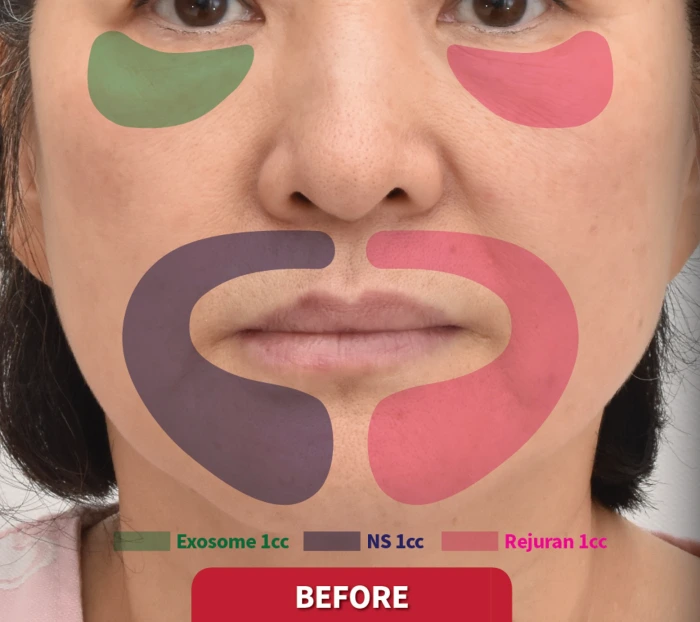 리쥬란과 엑소좀의 부위별 회복 속도 비교 연구