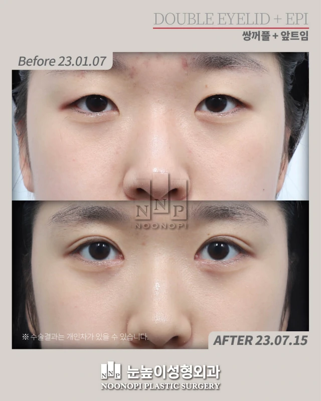 ptosis correction before after