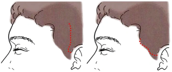 نوعان من الشقوق في منطقة الصدغ: داخل خط الشعر مقابل على طول خط الشعر