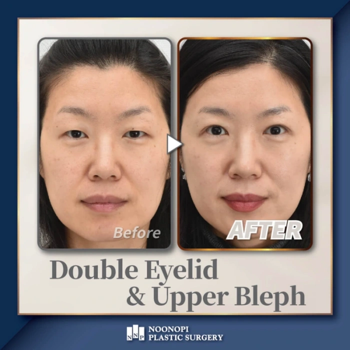 上睑下垂矫正案例