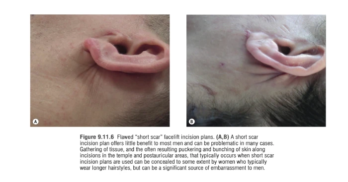 Real cases showing skin bunching after mini incision technique