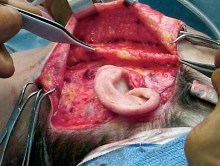 皮瓣提升后收紧SMAS层