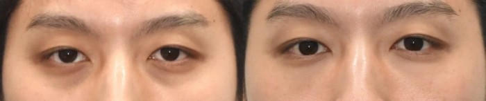 无创LB术联合纳米脂肪填充治疗黑眼圈