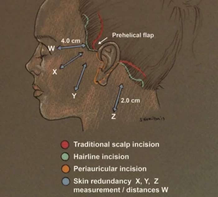 two kinds of incision placement during facelift