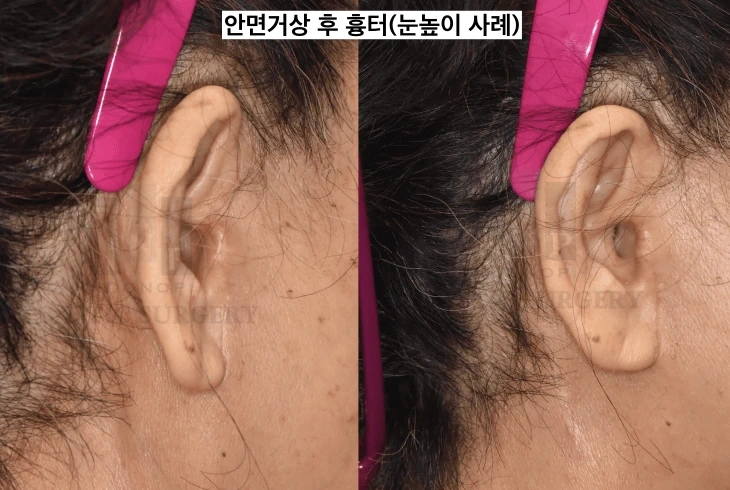 ندوب أقل ظهورًا بعد عملية شد الوجه