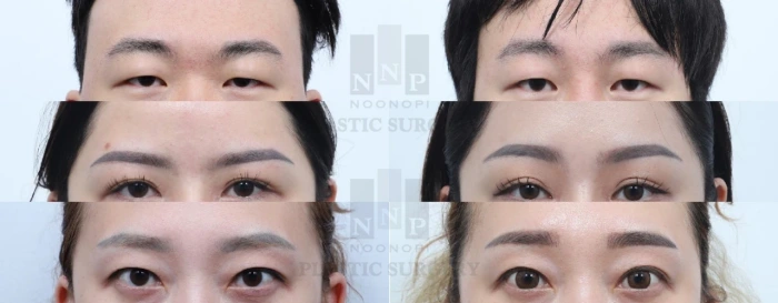 年轻时接受内窥镜眉部提升术的案例