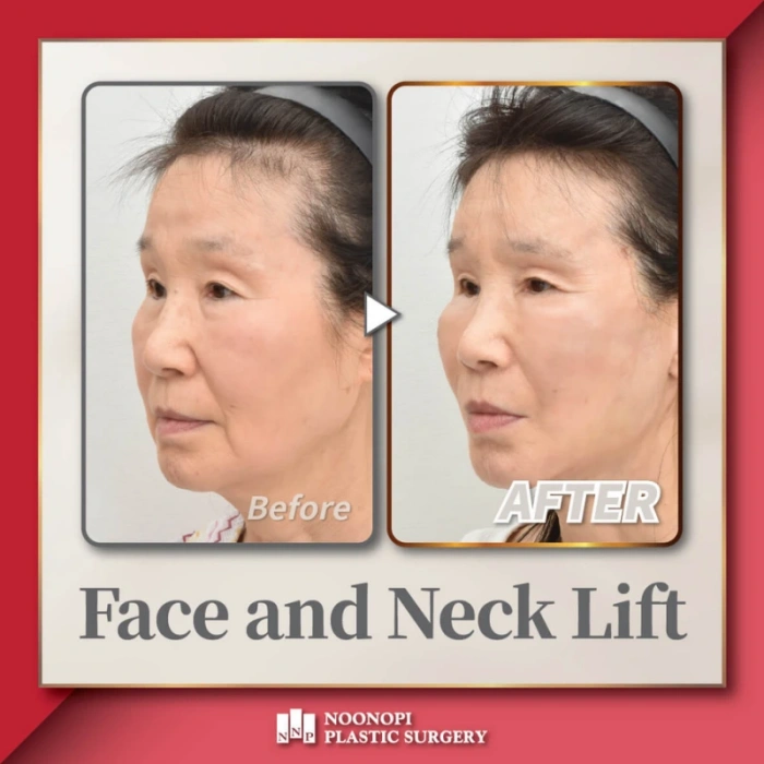 حالة شد الوجه والرقبة وزرع الدهون. بعد الجراحة 16 يومًا