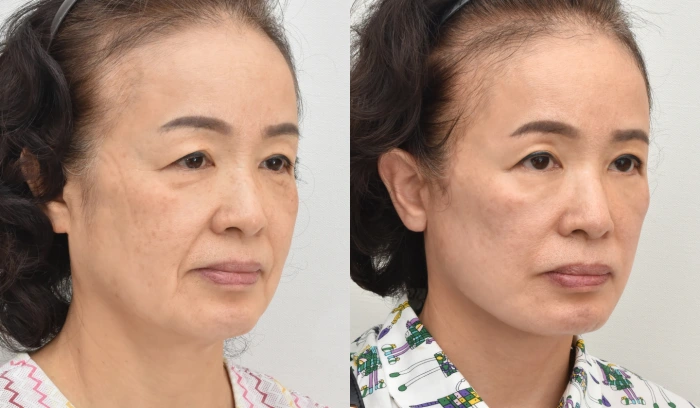 안면거상재수술 성형외과