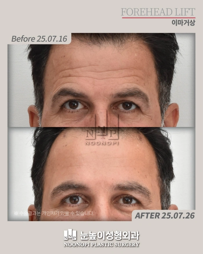 在Noonopi进行内窥镜提眉术后的皱纹变化