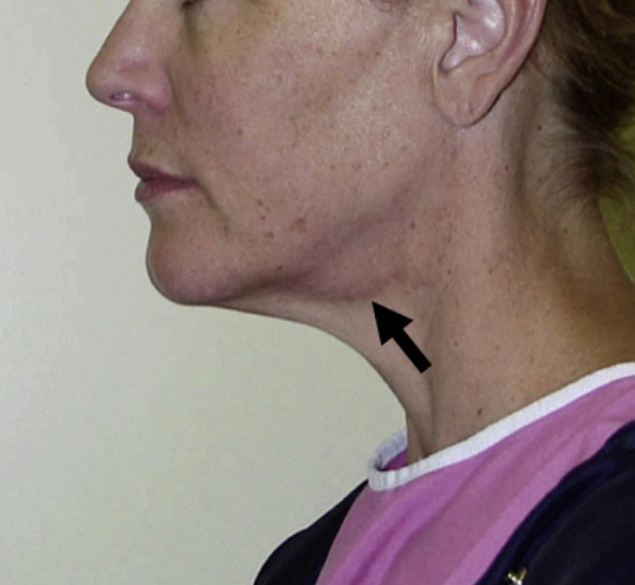 حالة الغدة تحت الفك السفلي البارزة