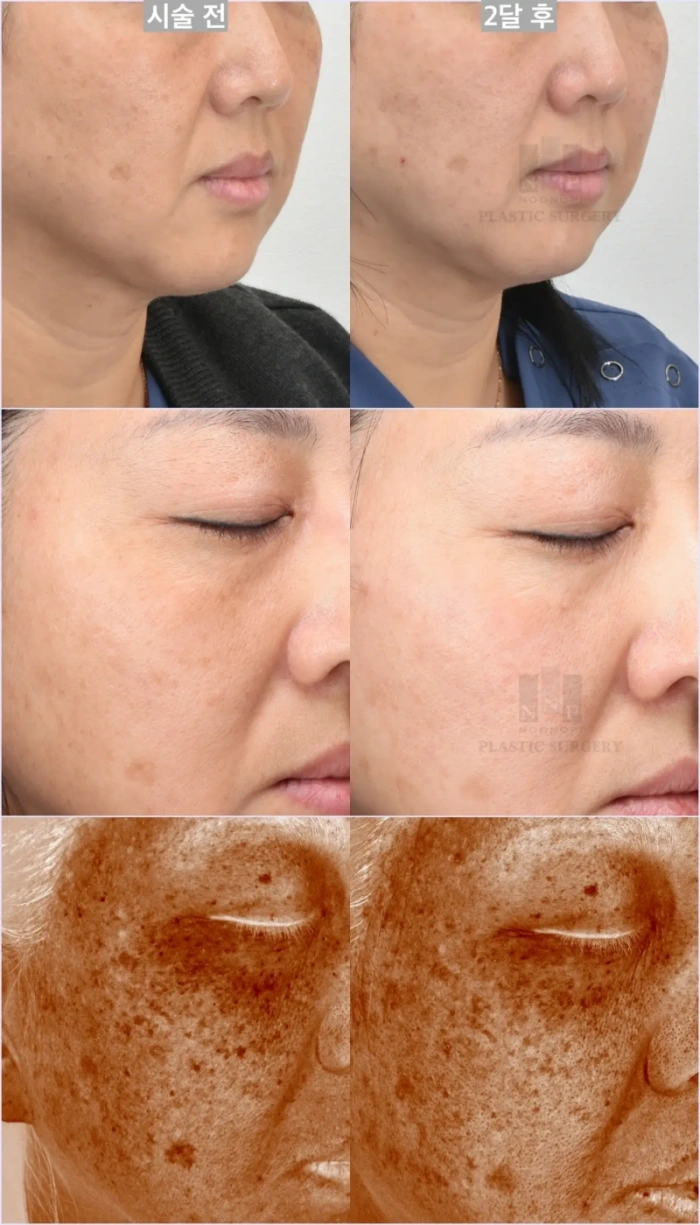 히어로 레이저 전후 모습