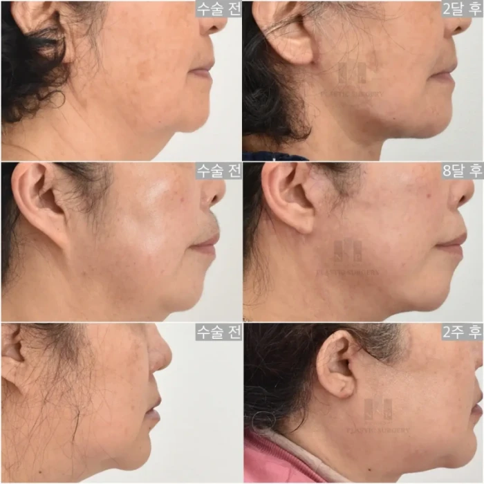 안면거상술 후 귀 모양 근접 사진