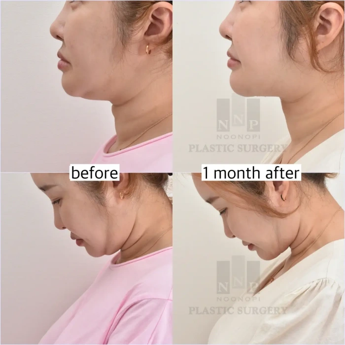 腺体缩减后轮廓更锐利(头部前倾时)