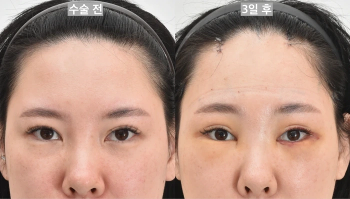 قبل وبعد جراحة شد الجبهة باستخدام تقنية إندوتين