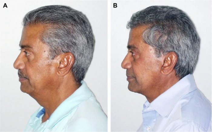 صورة بعد شهرين لمريضة من أصل هندي (تجديد شباب الوجه السفلي في الوجه غير القوقازي)