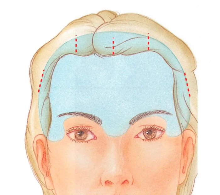 endoscopic brow lift incision placement