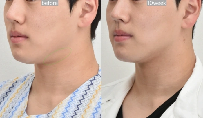 韩国颈部拉皮手术