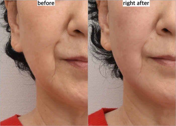 XERF Before and After Comparison at Noonopi Plastic Surgery, Korea