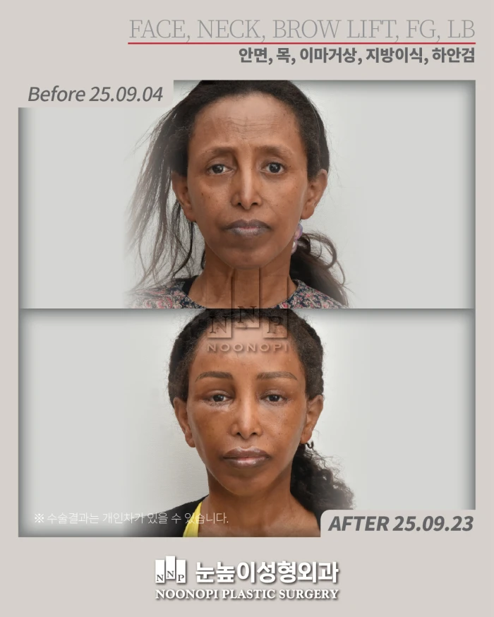 颧骨较小可使面部提升效果更显著