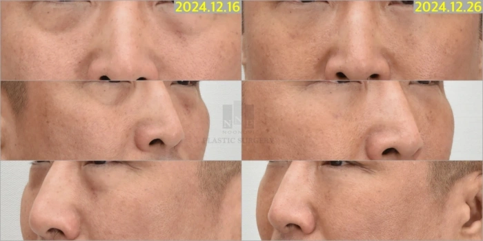 눈밑지방재배치 전후 사례